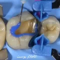 تسوس الاسنان